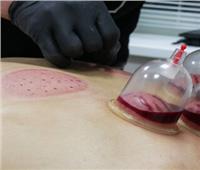الحجامة تراث يتحدى الزمن